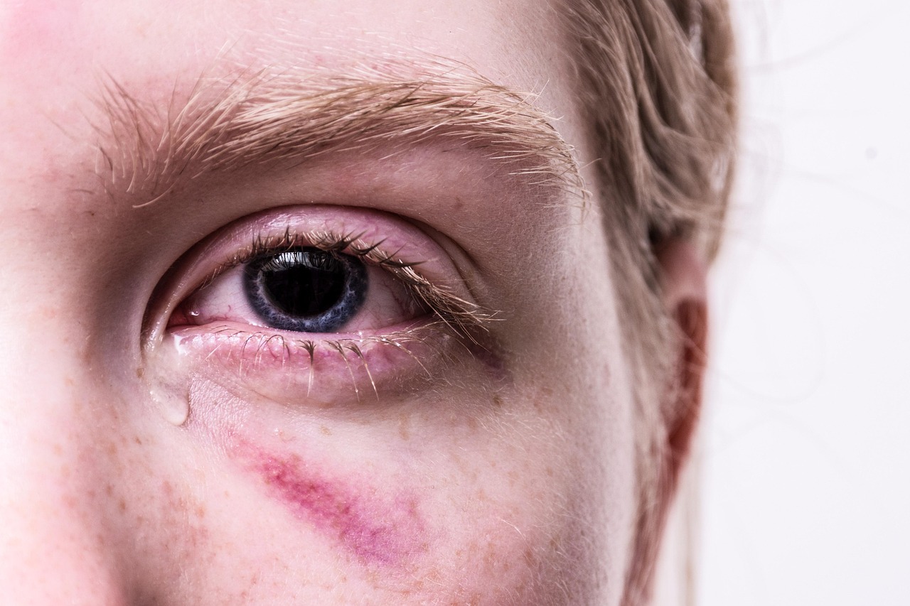 trauma, injured, tear, traumatized, pain, injury, cry, hematoma, tormented, suffering, eye, bruise, problem, tears, girl
